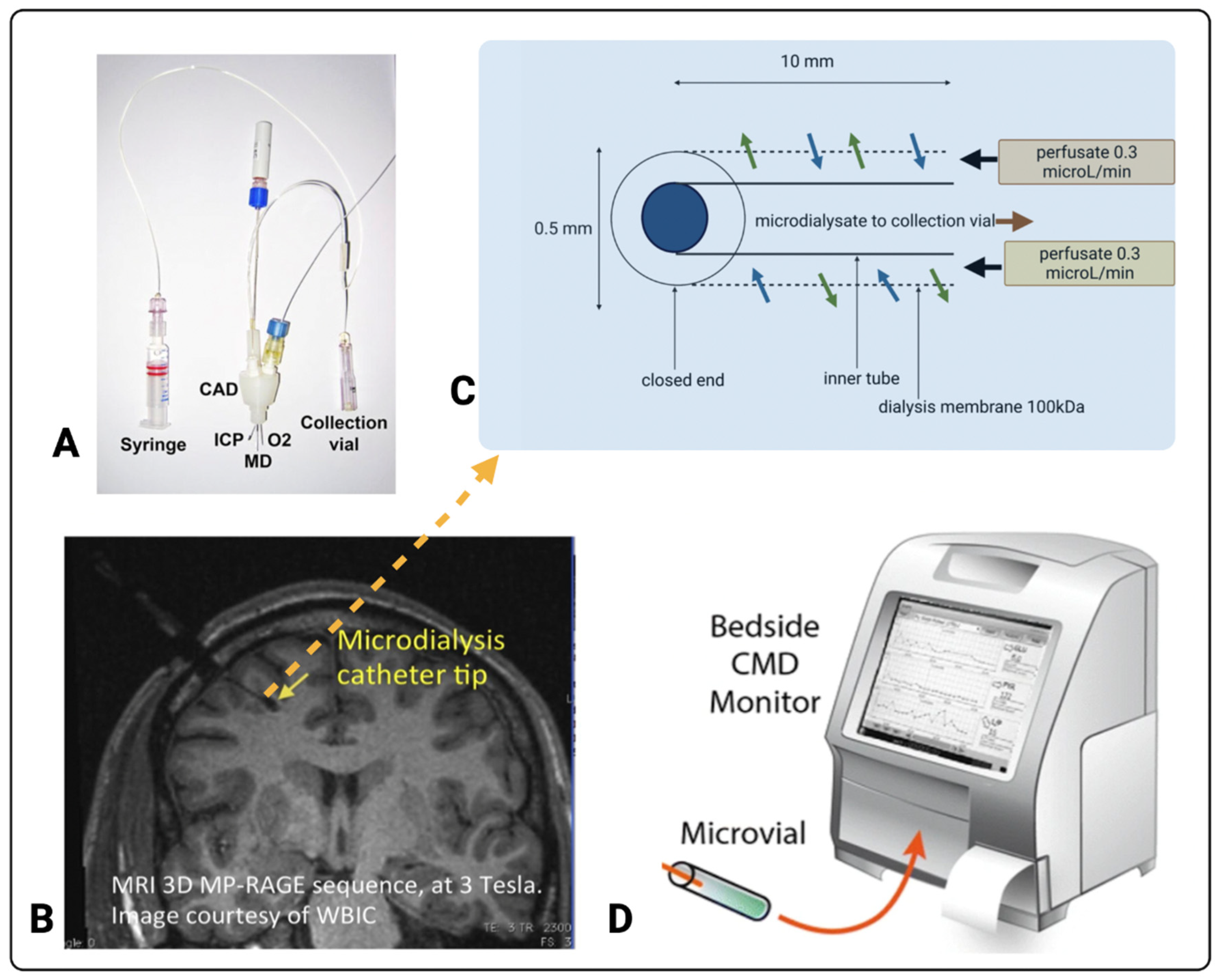 Monitoring Neurochemistry in Traumatic Brain Injury Patients Using ...