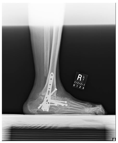 Metals 08 00180 g0a2