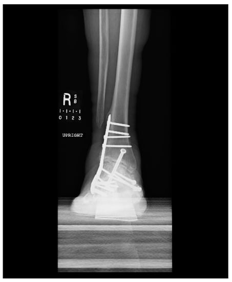 Metals 08 00180 g0a3