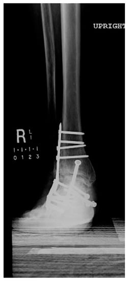 Metals 08 00180 g0a4