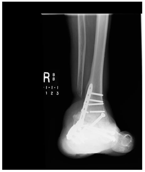 Metals 08 00180 g0a6