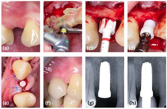 A representative case from the TL group. (a) Missing maxillary premolar, (b) partially guided implant bed preparation, (c) bone profiling with a Neck Expansion Drill, (d) manual insertion of the implant with a hand ratchet, (e) suturing, (f) prosthetic loading, (g) baseline radiograph, (h) 24-month radiograph.