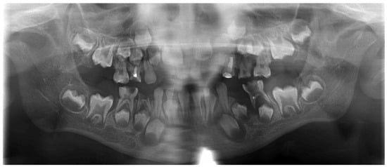 Panoramic radiographic features of dentomaxillofacial involvement in mucopolysaccharidosis (MPS). Representative panoramic radiograph illustrating delayed development and eruption of the permanent dentition, bilateral enlargement of the mandibular notches, and underdevelopment of the mandibular condyles.