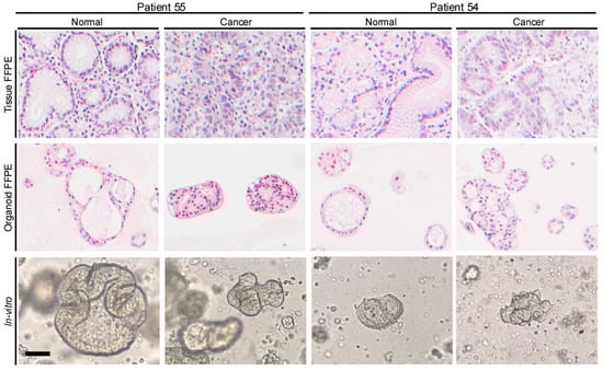 Histology and morphology of whole tissue and organoid specimens. Representative images of normal and cancer tissues for two enrolled patients. Patient identification and normal/cancer designation denoted by top labels. Specimen type is denoted by the left labels. Whole tissue and organoid formalin-fixed paraffin-embedded (FFPE) are stained with hematoxylin and eosin (top two rows). In vitro images of organoids taken through Matrigel during initial passage for patient 55 and passage 1 for patient 54 (last row). Images captured at 20× using AxioCam HRc camera. The scale bar represents 50 μm. Note that this figure contains novel images of organoids used in previous research (see Section 2).