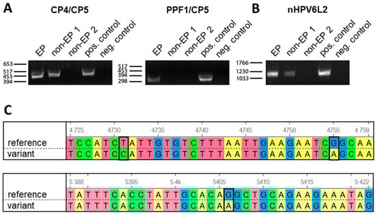 Detection and identification of HPV in the esophageal tissues. (A) Broad-spectrum HPV PCRs with primer pairs CP4/CP5 and PPF1/CP5 were used for detection of HPVs in the esophageal tissues. Tissues were obtained from a patient with extensive papillomatosis (EP) and from two patients with multiple esophageal squamous papillomas (non-EP 1 and non-EP 2). Amplicons at the expected base pair sizes were observed in the EP patient and in the non-EP patient 1 ((left); CP4/CP5 at 450 base pairs) and in the EP patient ((right); PPF1/CP5 at 280 base pairs), but not in both non-EP patients. (B) To determine the individual HPV6 variant, a nested PCR using nHPV6L2 primers, recognizing a conserved part within L2, was performed. HPV6L2-specific bands at the expected size of 1073 base pairs were observed in the virus-positive tissues, including the sample derived from the EP patient. DNA isolated from an HPV6-positive anogenital wart (pos. control) and water (neg. control) served as the respective positive and no-template controls in the PCRs. (C) Sequencing of the HPV6L2 isolates derived from the esophageal tissues as compared to the HPV6b reference genome (GenBank accession number X00203) revealed a virus variant belonging to the HPV6 lineage A. The three single nucleotide polymorphisms detected in both virus-positive samples are annotated.