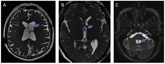 Images of ventricular neurocysticercosis (3D MRI). (A): Lateral ventricle; (B): Third ventricle; (C): Fourth ventricle. The arrows indicate the parasite in each figure.