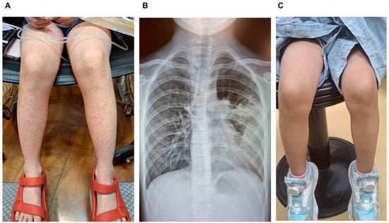 (A) Representative photograph of the severe, widespread, pruritic urticaria affecting the face, trunk, and extremities, shown here on the lower extremities, before Omalizumab treatment. (B) The Chest X-ray shows a prominent consolidation in the left mid and lower lung lobes, characterized by the presence of an air bronchogram sign. (C) After Omalizumab treatment, the urticaria resolved rapidly the following day.