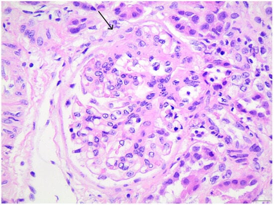 On light microscopy (H&amp;E ×400), a small area of segmental glomerular sclerosis is visible, forming a minor synechia with Bowman’s capsule at the top of the image, as indicated by the arrow.