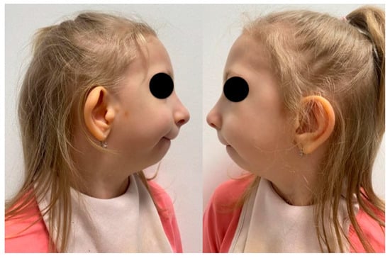 Extraoral photograph of the patient’s face from the lateral view, with significant hypoplasia of the mandible.