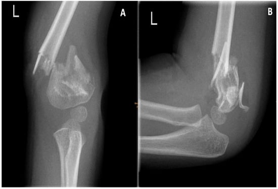 Images of the fracture. (A) A.p. image shows complete dislocation, lateral and medial comminution. (B) Lateral image also depicting multiple fragments.