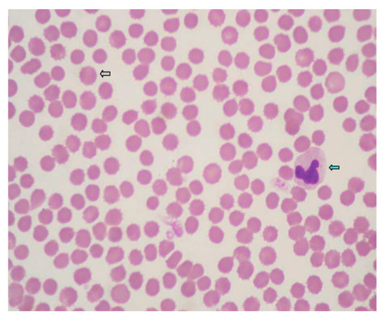 Blood smear of one of the dogs (ID1) included in the study. Venom within 24 h of the event. Sphero-echinocytes (erythrocytes lacking central pallor with a jagged outline and regular spicules along their entire circumference) (grey arrow). A neutrophil with a visible Döhle body inside (blue arrow). There is an almost total absence of platelets. Wright, 100× (immersion).