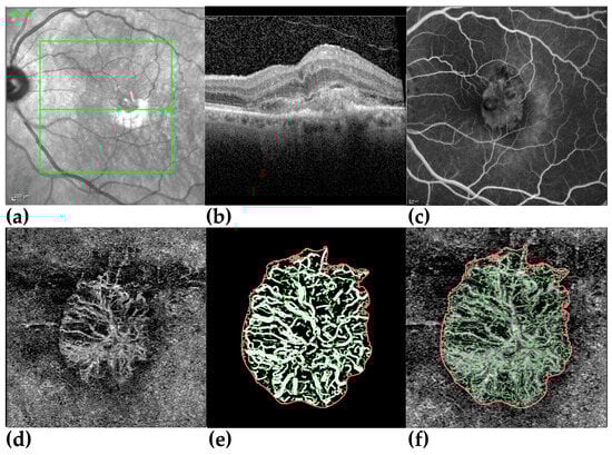 Overview of a case with typical type 2 MNV in IR image (a) with a green line referring to the corresponding OCT slice (b), FA (c), en-face view of the ORCC segmentation in OCTA (d), magnified view of the binarized vessels (e), and the skeletonized vessels (f).