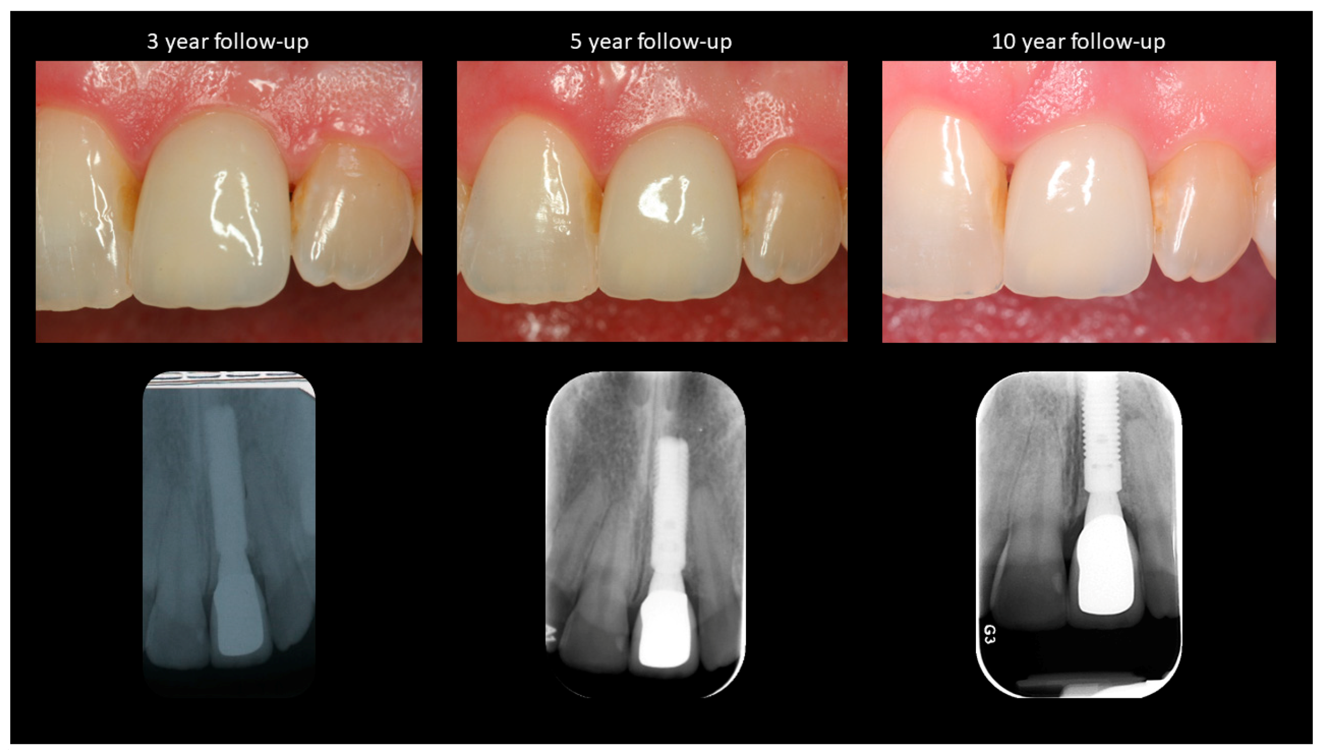 Prosthesis 03 00014 g003 Prosthesis 03 00014 g003