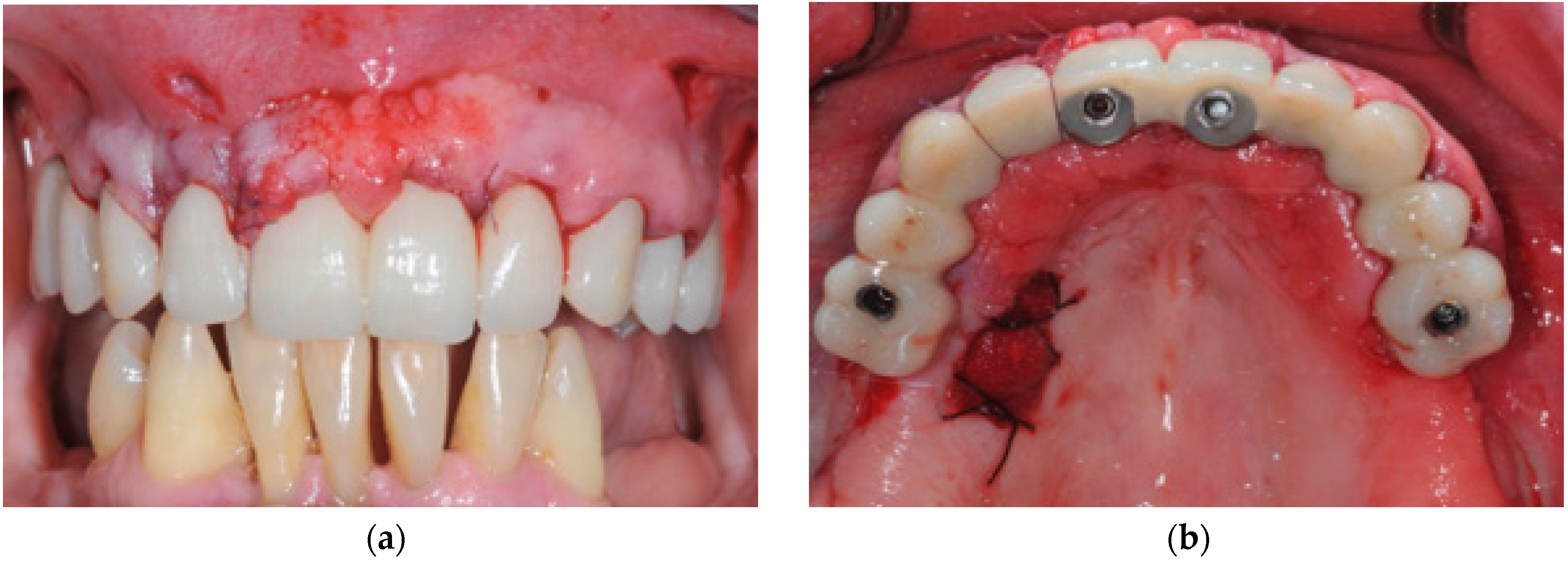 Prosthesis 04 00020 g005 Prosthesis 04 00020 g005