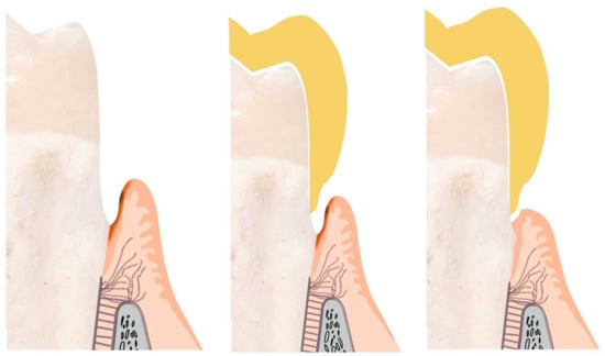 Prosthesis 05 00026 g006