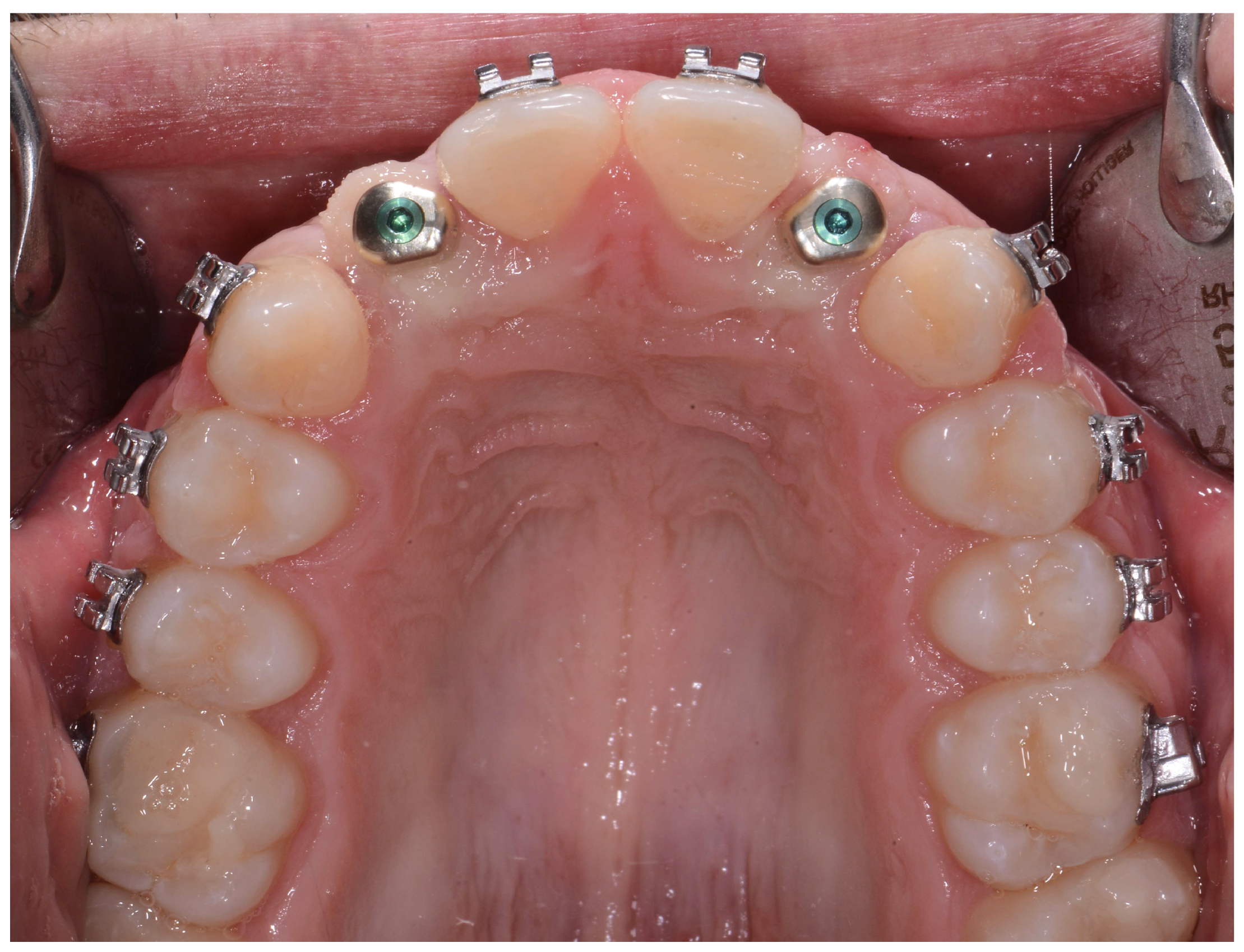 Prosthesis 06 00057 g003 Prosthesis 06 00057 g003