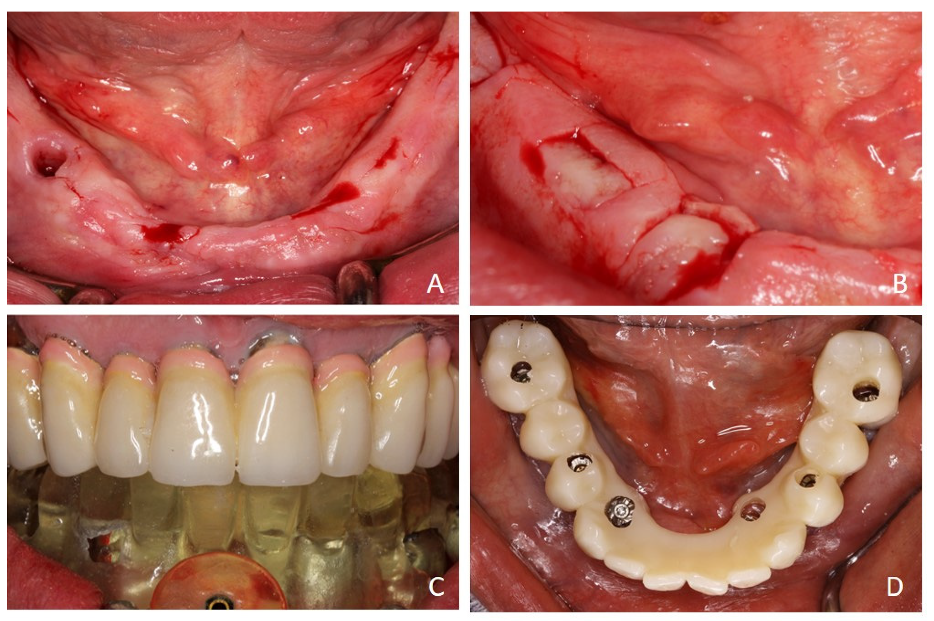 Prosthesis 07 00025 g005 Prosthesis 07 00025 g005