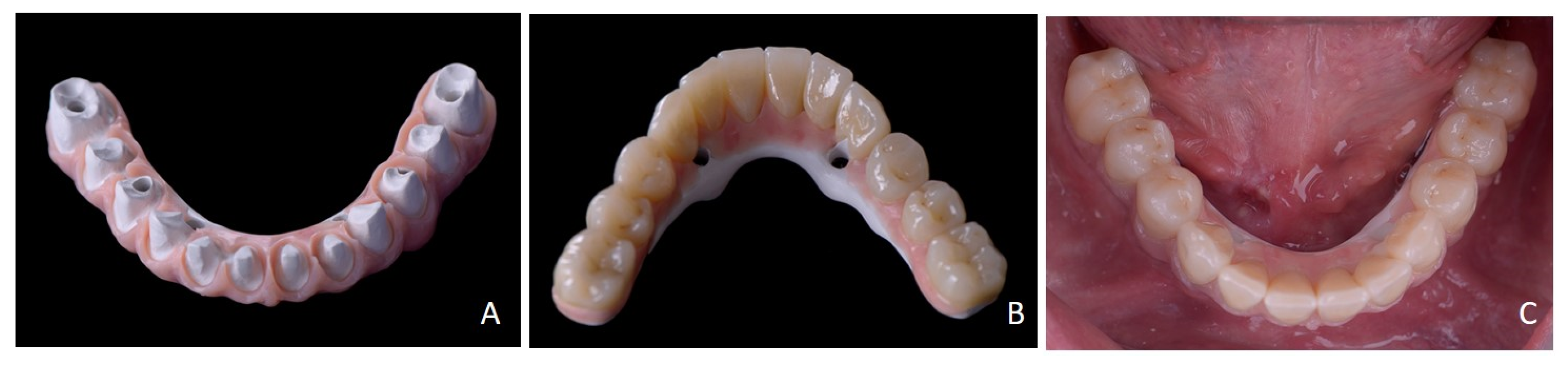 Prosthesis 07 00025 g008 Prosthesis 07 00025 g008