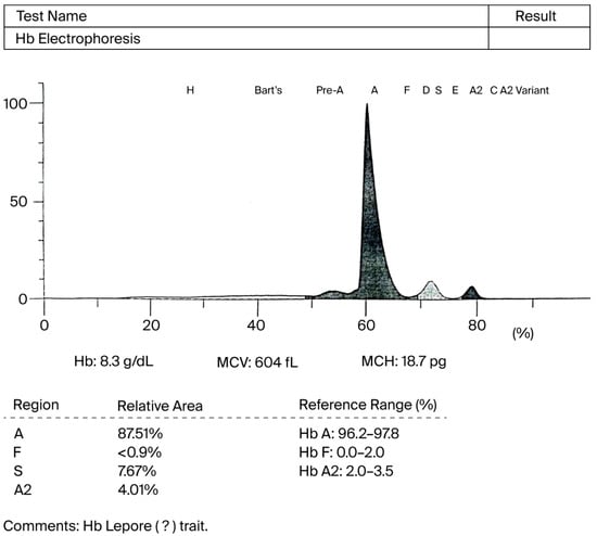 Capillary Hb electrophoresis showing an abnormal pattern with mild elevation in HbS, normal Hb F, mildly reduced HbA, and high HbA2, suggesting a heterozygous beta chain variant of Hb Lepore.