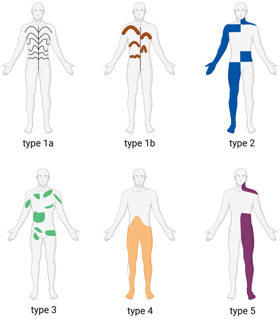 Six distinct patterns of the distribution of localized scleroderma originating from somatic mosaicism from Reference 24, with some modifications. Type 1a. Narrow sclerotic plaque aligned with the Blaschko line. Type 1b. Broad sclerotic plaque aligned with the Blaschko line. Type 2. Checkerboard pattern. Type 3. Leaf-like pattern. Type 4. Patchy pattern without midline separation. Type 5. Lateralization pattern. Created in BioRender by Takahashi, T. (2025). BioRender.com/rz6725v.