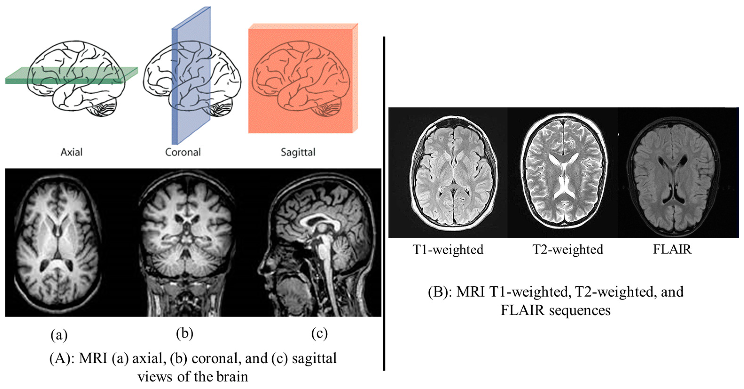 Advanced Deep Learning and Machine Learning Techniques for MRI Brain ...