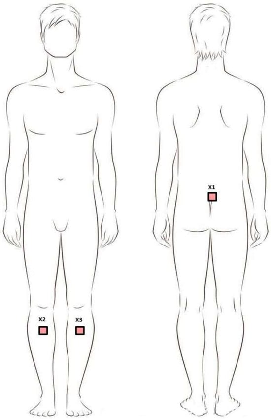Positioning of sensors during the study. Legend: X1—sacral sensor; X2—sensor on the right shin; X3—sensor on the left shin.