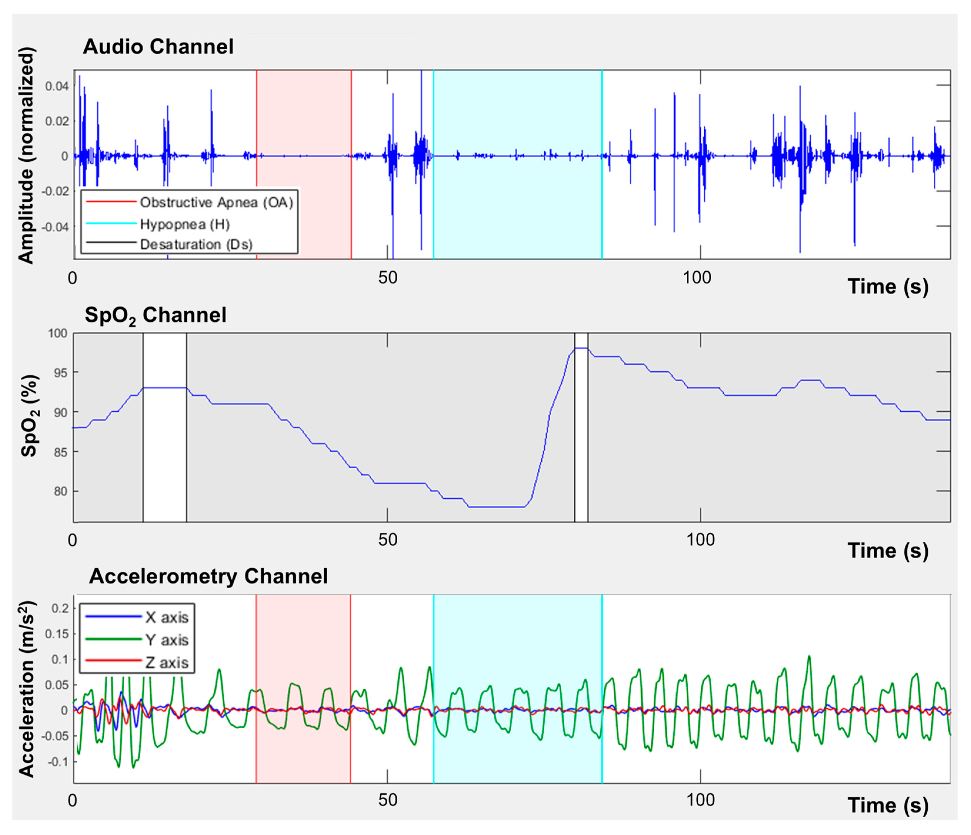Early Screening of Sleep-Disordered Breathing Using a Smartphone-Based ...