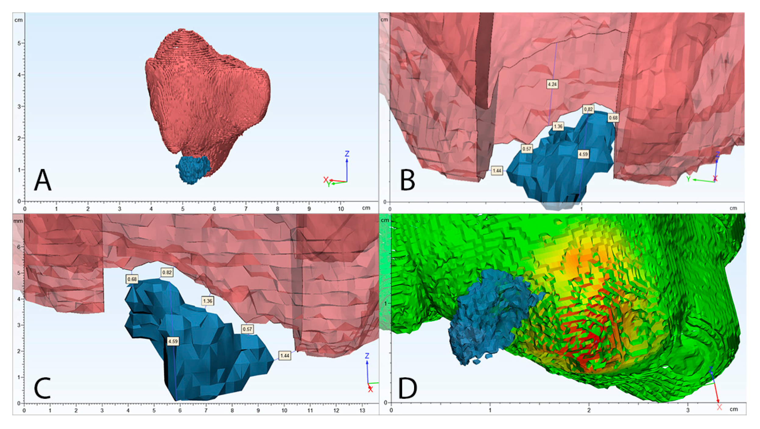 Sinusitis 04 00003 g004
