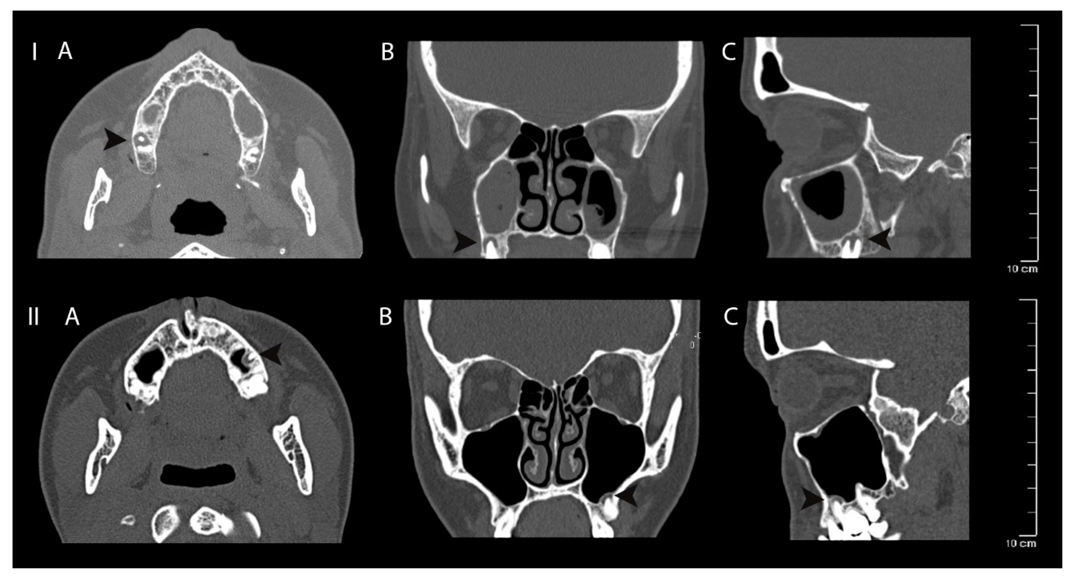 Sinusitis 04 00003 g005