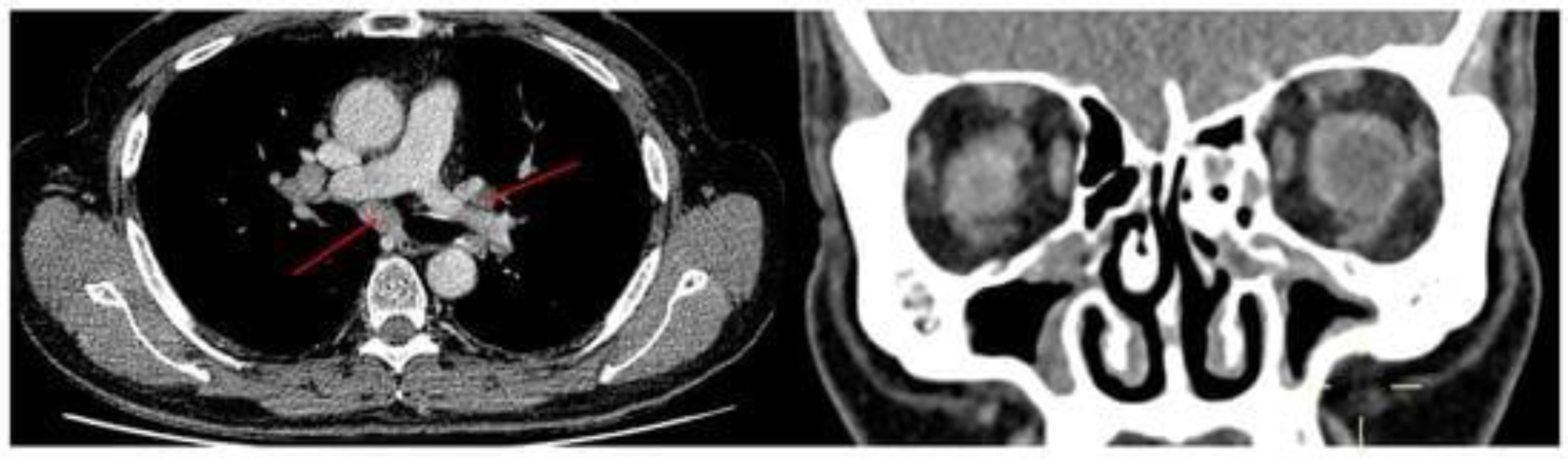Sinusitis 06 00003 g002