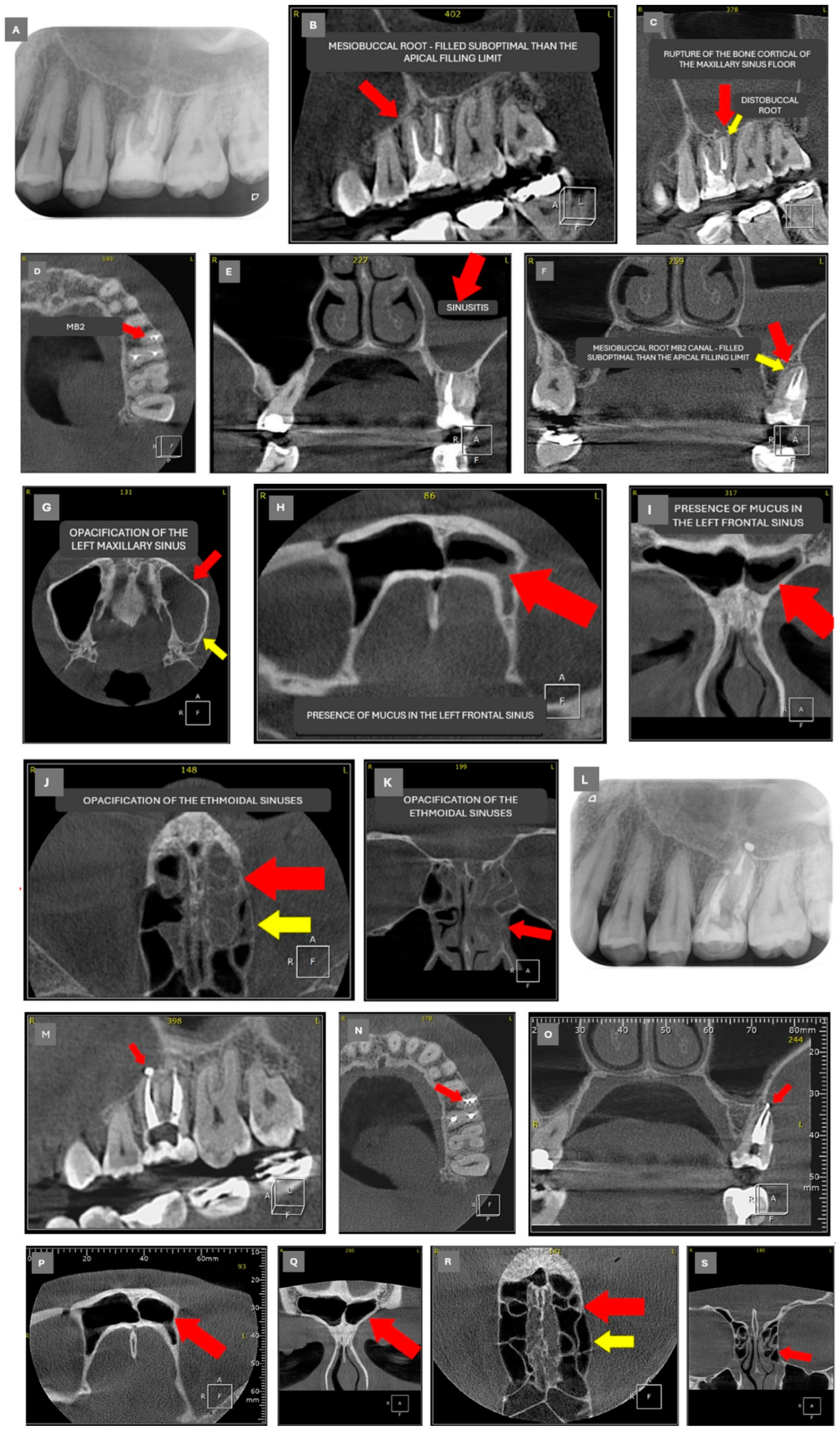 Sinusitis 09 00001 g002