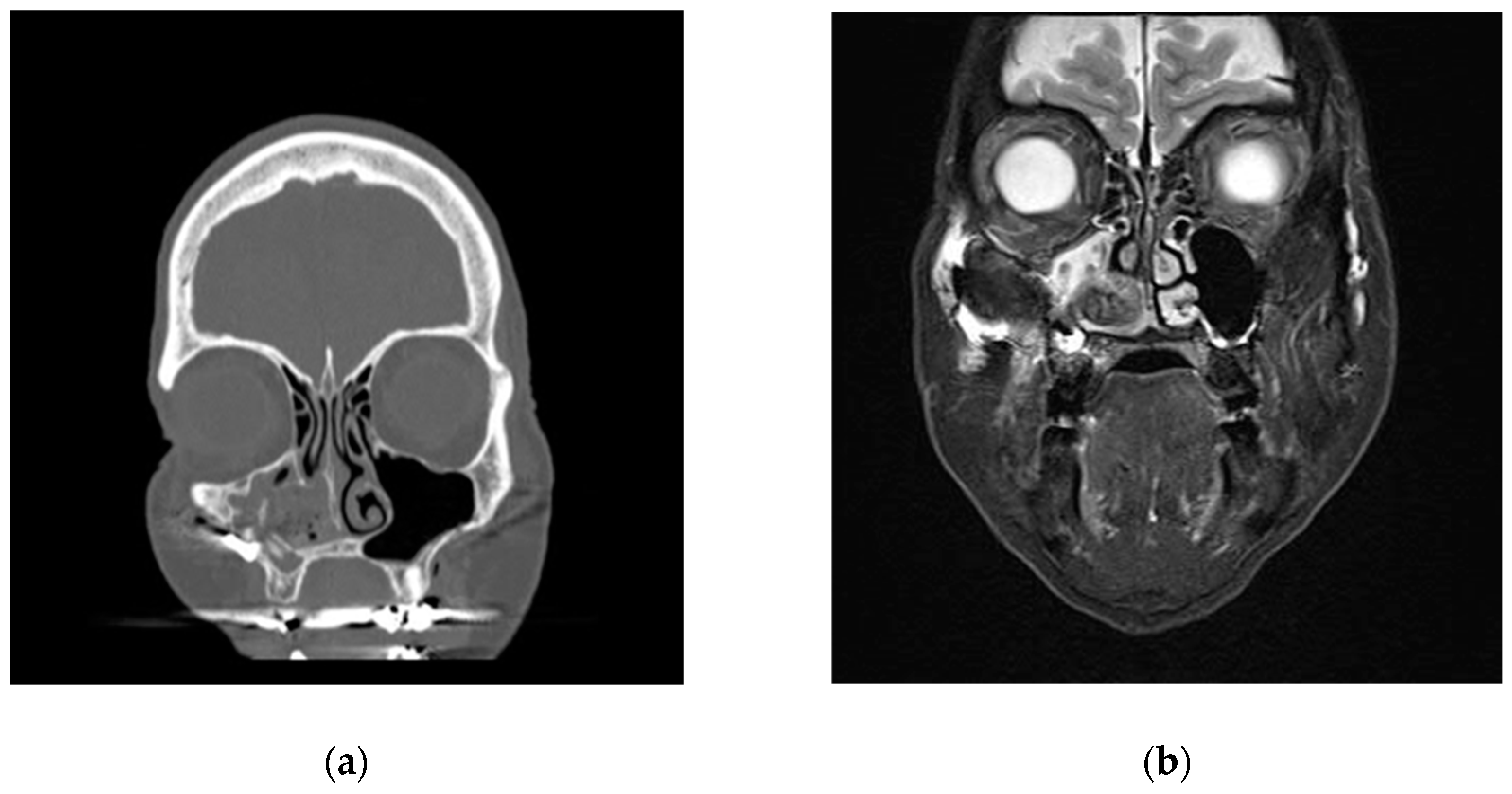 Sinusitis 09 00002 g001