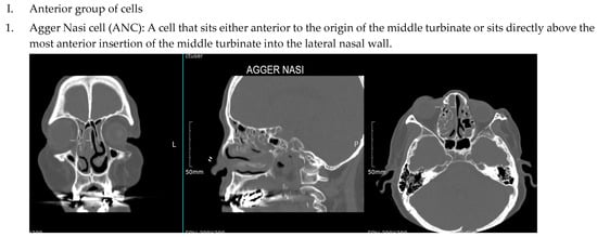 Sinusitis 09 00014 g001a Sinusitis 09 00014 g001a