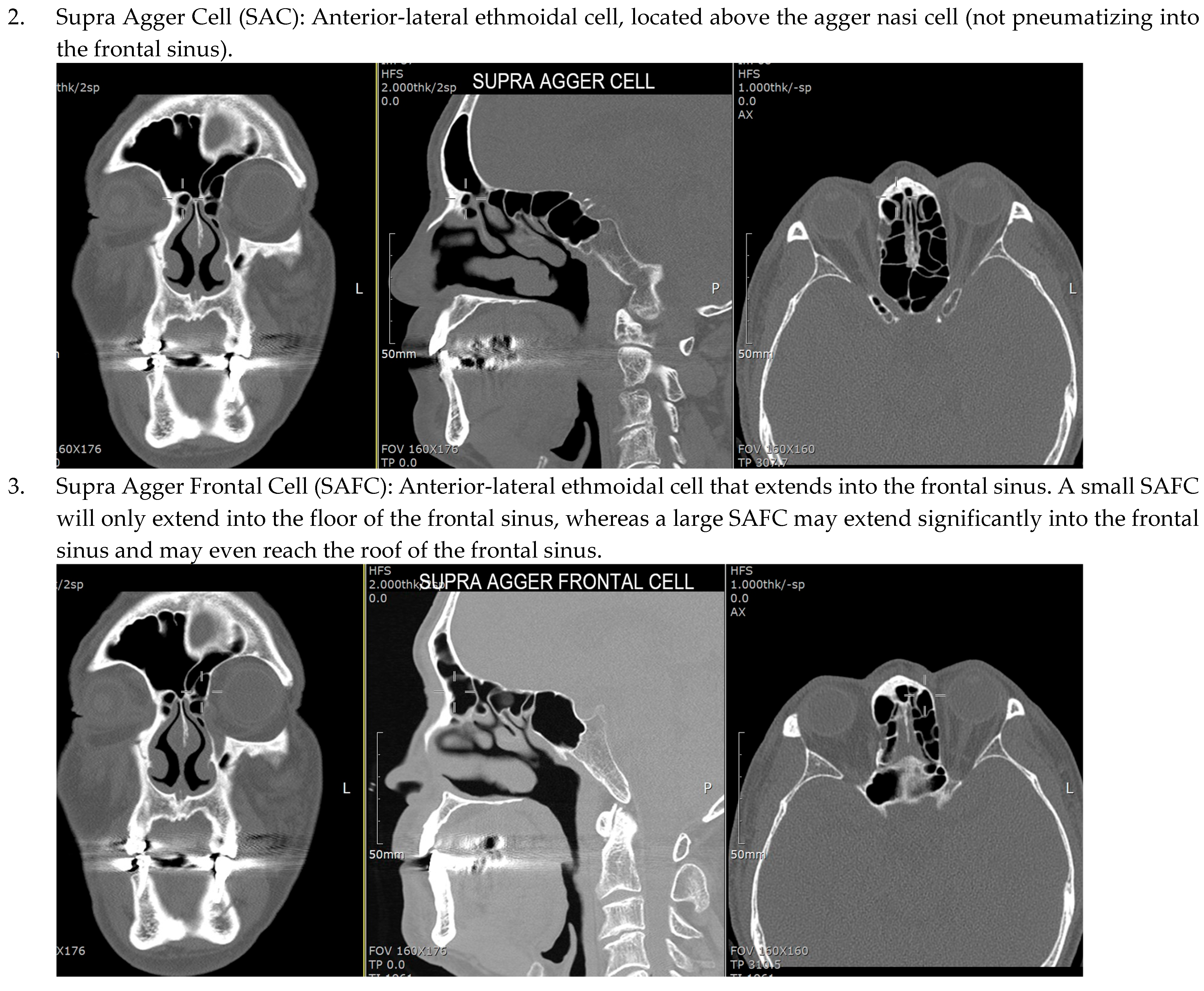 Sinusitis 09 00014 g001b Sinusitis 09 00014 g001b
