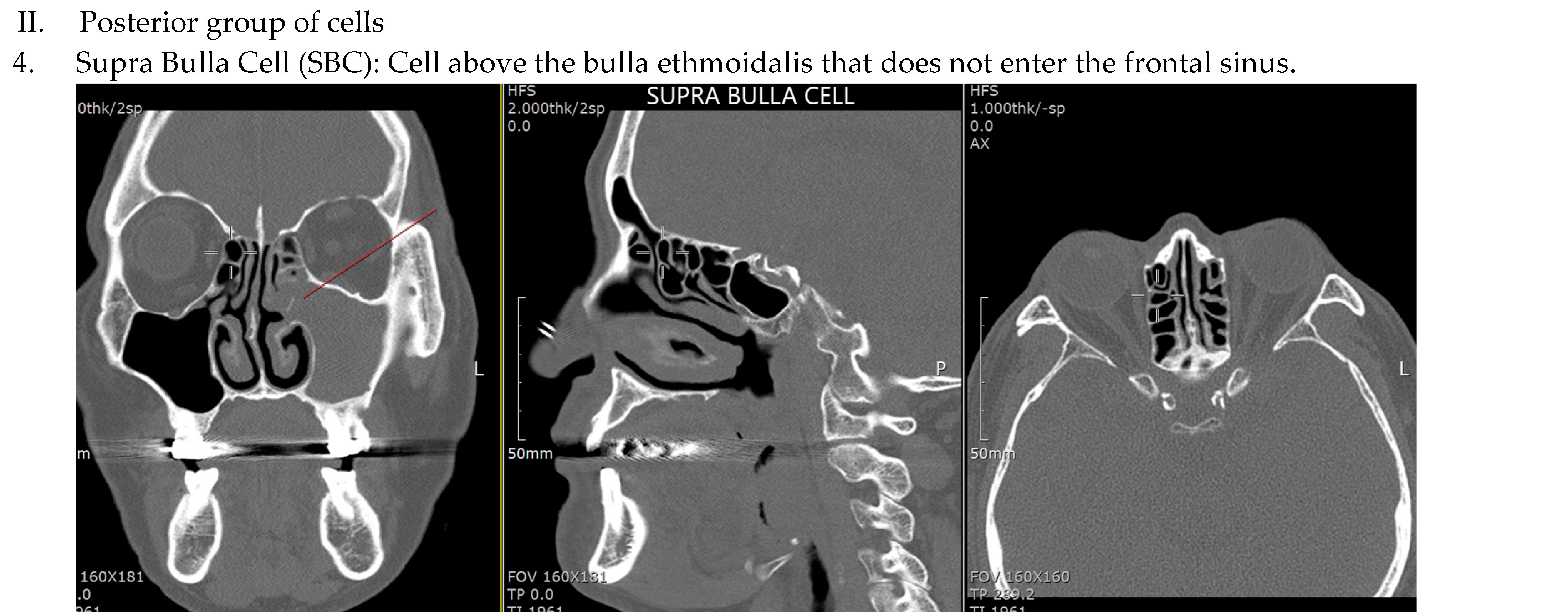 Sinusitis 09 00014 g001c Sinusitis 09 00014 g001c