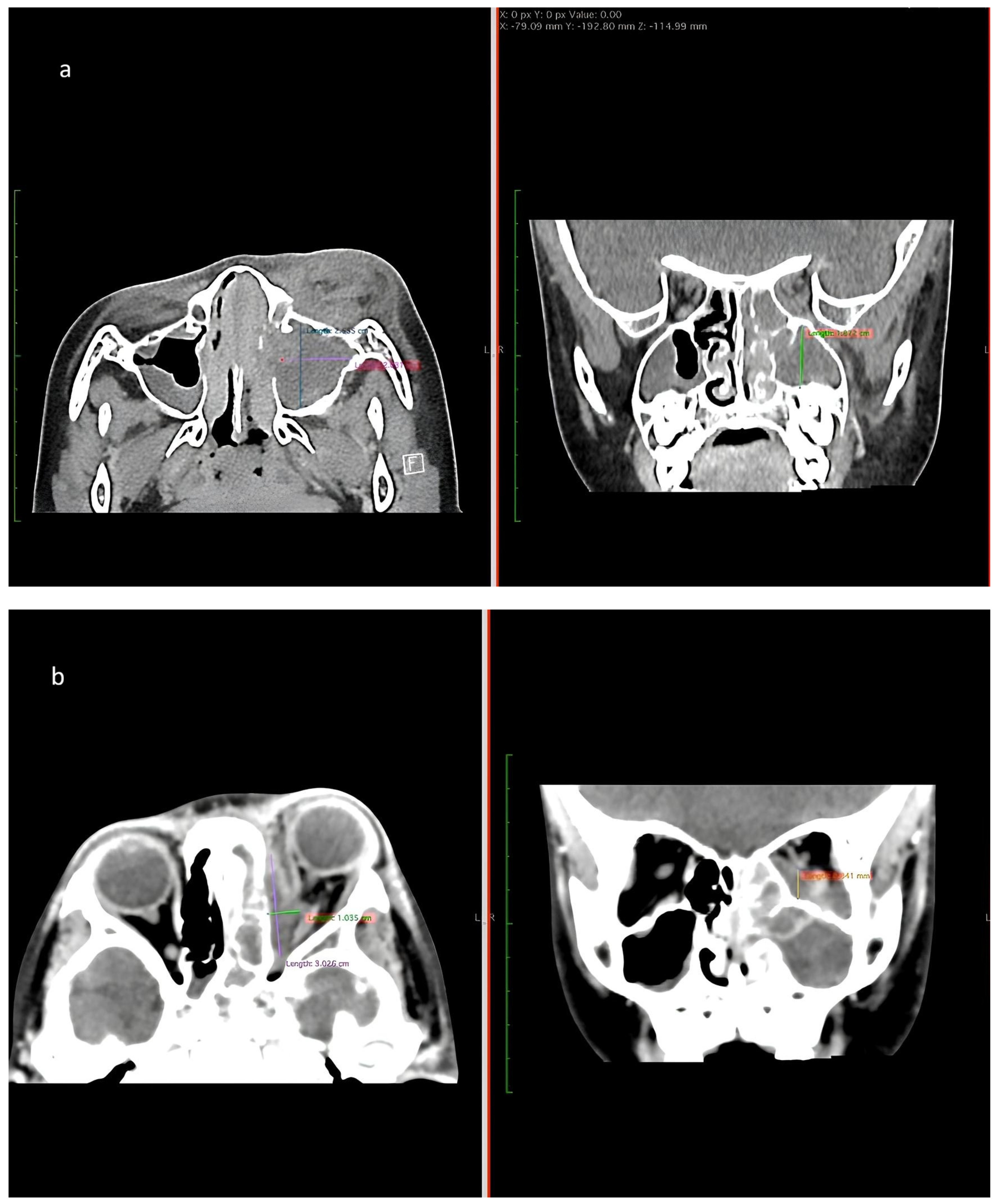 Sinusitis 09 00021 g003