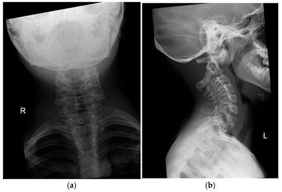 X-ray images of patient’s cervical spine at initial presentation in (a) antero-posterior (AP) and (b) lateral directions, respectively. Images show marked anterolisthesis of C1 over C2. Otherwise, the remaining vertebral bodies and corresponding disc spaces are maintained. There is also no significant prevertebral soft tissue thickness to indicate a possible underlying infective etiology. (Abbreviations: R = right and L = left).