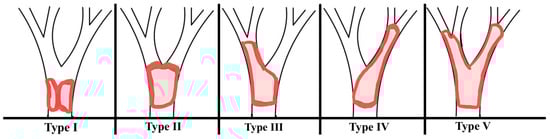 Schematic diagram of the Bismuth–Corlette classification of hilar cholangiocarcinoma (HCCA). Type I: limited to the common hepatic duct, below the level of the confluence of the right and left hepatic duct; Type II: involves the confluence of the right and left hepatic ducts; Type III: type II and extends to involve the origin of the right hepatic duct; Type IV: type II and extends to involve the origin of the left hepatic duct; Type V: extending to and involving the origins of both right and left hepatic ducts (segmental ducts) and/or multifocal involvement.