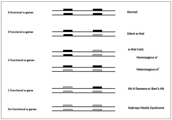 Schematic representation of the genotypic classification of alpha thalassemia and association with phenotypic expression. Gray rectangles represent deleted α genes; black rectangles represent normal or functional α genes. Legend: α-thal: α-thalassemia; α+: -α; α0: --.