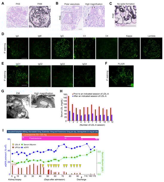 Clinical course and manifestations of the present case with DN and MN treated with LDL-A. (A) Representative images of Kimmelstiel–Wilson nodular lesions on PAS and PAM staining. Scale bar: 50 µm. (B) Representative images of polar vasculosis on PAS staining. Scale bar: 50 µm. Arrows; polar vasculosis. (C) No spike formation on PAM staining. Scale bar: 50 µm. (D) Immunofluorescence staining for immunoglobulins and light chain deposition along the GBM. Scale bar: 50 µm. (E) Immunofluorescence staining for IgG subclass deposition along the GBM. Scale bar: 50 µm. (F) Immunofluorescence staining for PLA2R deposition along the GBM. (G) Representative images of electron microscopy showing electron-dense deposits(EDD) along the GBM. Arrows; EDD. Scale bar: 2 µm. (H) Serum LDL levels before and after a session of LDL-A. (I) Clinical course of the present case before and after LDL-A, such as glucocorticoids and cyclophosphamide. The blue line indicates serum levels of albumin (g/dL) and the green line indicates estimated GFR (mL/min/1.73 m2). Red bars indicate the levels of proteinuria (UP/UCr). Magenta squares indicate the dose of prednisolone and orange squares indicate the dose of cyclophosphamide. PAS, periodic acid–Schiff; PAM, periodic acid–methenamine silver; GBM, glomerular basement membrane; LDL, low-density lipoprotein; LDL-A, LDL apheresis. UP/UCr, ratio of urine protein per urine creatinine.