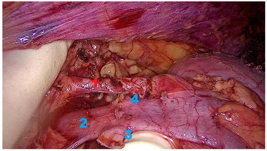 View of hilar vessels. 1. Renal artery 2. Renal vein 3. Left gonadal vein stump 4. Left adrenal vein stump.