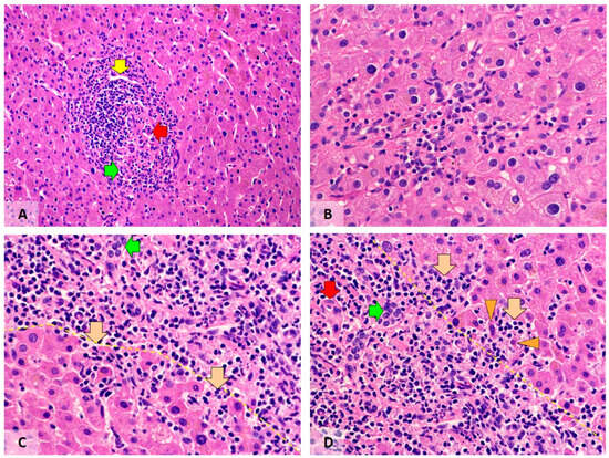 Inflammatory changes in liver tissues of post-COVID-19 patients. (A) Inflammation in a portal field. Green arrow, portal bile duct; red arrow, arteriole; yellow arrow, portal venule. (B) Lobular inflammation. (C,D) Different foci of periportal activity. Green arrows, portal bile duct; red arrow, arteriole; yellow dotted line, imaginary terminal plate line; brown arrows, periportal infiltrates; orange arrowheads, hepatocytes showing degenerative changes. Visualisation by haematoxylin–eosin stain; original magnification 100× (A) and 400× (B–D).