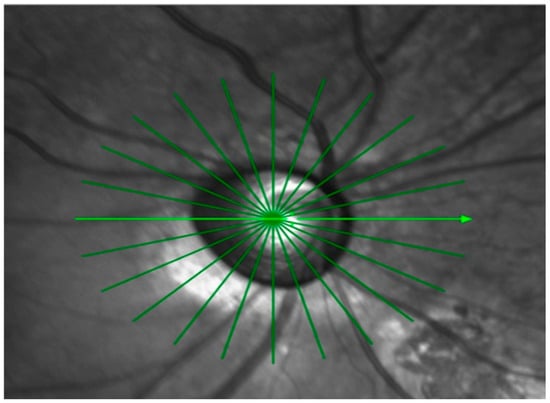 Optic nerve head radial scan centered on Bruch’s membrane opening (BMO) obtained using Spectralis SD-OCT. The 12-radial, 15° high-resolution scan pattern is shown.